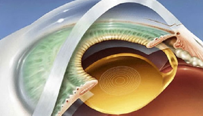 Cirurgia de Catarata - Instituto de Olhos IOP